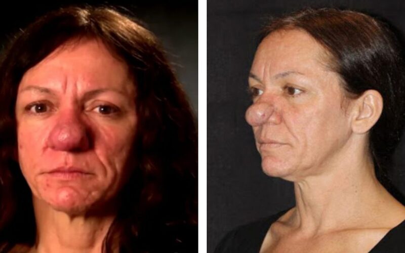  This woman with a huge strange nose became completely different after the plastic surgery