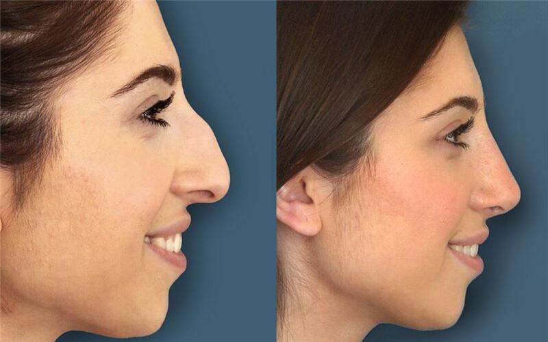  .”The nose is the head of everything.” Photos of girls who have been transformed by rhinoplasty