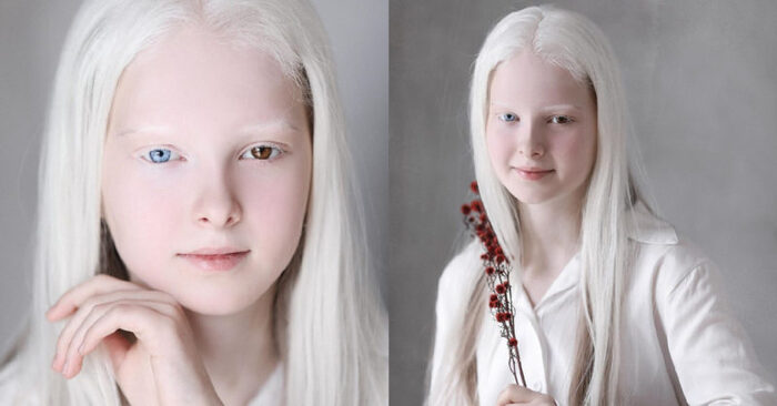  Girl with different colored eyes: here is one of the most beautiful and unique albinos in the world