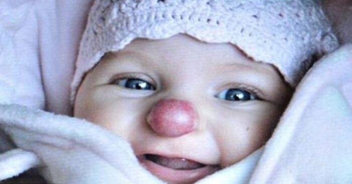 Unusual baby: this is what a unique girl who was born with an unusual nose looks like now