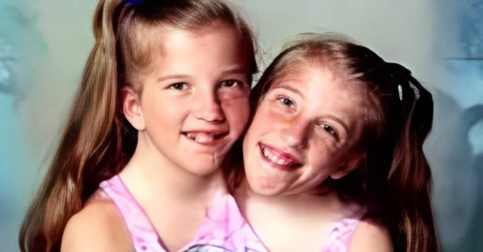  «Life is one but it is for two»: this is how the most famous Siamese twins look now